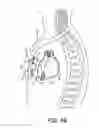 Fig. 09 - Substernal leadless electrical stimulation system
