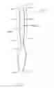 Fig. 12 - Apparatus and method using near infrared reflectometry to reduce the effect of positional changes during spinal cord stimulation