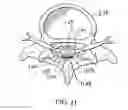 Fig. 13 - Apparatus and method using near infrared reflectometry to reduce the effect of positional changes during spinal cord stimulation