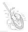 Fig. 01 - System and method for transaortic delivery of a prosthetic heart valve