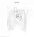 Fig. 02 - System and method for transaortic delivery of a prosthetic heart valve