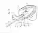 Fig. 03 - System and method for transaortic delivery of a prosthetic heart valve