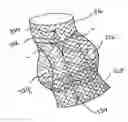 Fig. 01 - Personalized aortic valve prosthesis