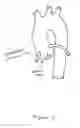 Fig. 02 - Personalized aortic valve prosthesis