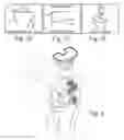 Fig. 07 - Method of designing orthopedic implants using in vivo data