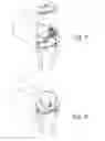 Fig. 08 - Method of designing orthopedic implants using in vivo data