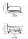 Fig. 08 - METHODS AND SYSTEMS FOR MINIMIZATION OF MECHANICAL EFFECTS OF IMPACT VELOCITY DURING TISSUE PRESERVATION