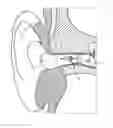 Fig. 01 - Inflatable ear mold with protected inflation air inlet
