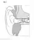 Fig. 02 - Inflatable ear mold with protected inflation air inlet