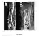 Fig. 06 - Regenerative autologous bone marrow cell therapies and methods for their use in the treatment of joint pain