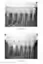 Fig. 07 - Floss device, a method of forming the floss device and a method of using the floss device
