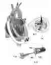Fig. 01 - System and method for heart pump interrogation and inspection