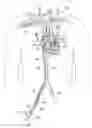 Fig. 01 - Transseptal cannula, tip, delivery system, and method