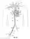 Fig. 02 - Transseptal cannula, tip, delivery system, and method