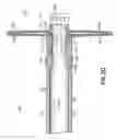 Fig. 33 - Transseptal cannula, tip, delivery system, and method