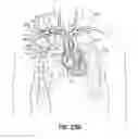Fig. 40 - Transseptal cannula, tip, delivery system, and method