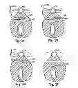 Fig. 28 - Systems, devices and methods for minimally invasive pelvic surgery