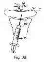 Fig. 52 - Systems, devices and methods for minimally invasive pelvic surgery