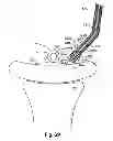 Fig. 53 - Systems, devices and methods for minimally invasive pelvic surgery
