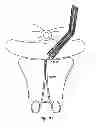 Fig. 55 - Systems, devices and methods for minimally invasive pelvic surgery