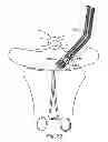 Fig. 56 - Systems, devices and methods for minimally invasive pelvic surgery