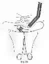 Fig. 57 - Systems, devices and methods for minimally invasive pelvic surgery
