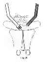 Fig. 58 - Systems, devices and methods for minimally invasive pelvic surgery