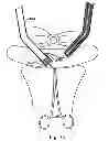 Fig. 59 - Systems, devices and methods for minimally invasive pelvic surgery