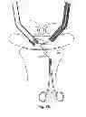 Fig. 60 - Systems, devices and methods for minimally invasive pelvic surgery
