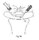 Fig. 63 - Systems, devices and methods for minimally invasive pelvic surgery