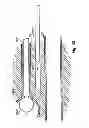 Fig. 70 - Systems, devices and methods for minimally invasive pelvic surgery