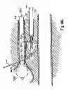 Fig. 76 - Systems, devices and methods for minimally invasive pelvic surgery
