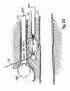 Fig. 77 - Systems, devices and methods for minimally invasive pelvic surgery
