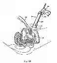 Fig. 84 - Systems, devices and methods for minimally invasive pelvic surgery