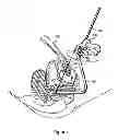 Fig. 85 - Systems, devices and methods for minimally invasive pelvic surgery