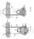 Fig. 87 - Systems, devices and methods for minimally invasive pelvic surgery