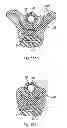 Fig. 89 - Systems, devices and methods for minimally invasive pelvic surgery