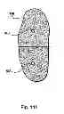 Fig. 93 - Systems, devices and methods for minimally invasive pelvic surgery