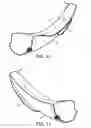 Fig. 06 - Guiding device for use with laryngoscope