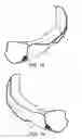 Fig. 08 - Guiding device for use with laryngoscope
