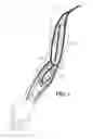 Fig. 02 - Arteriovenous access valve system and process