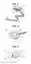 Fig. 03 - Infusion set with quick connect, self-aligned electrical contacts