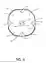 Fig. 05 - Retention drainage catheter