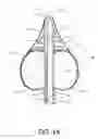 Fig. 15 - Retention drainage catheter