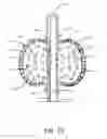 Fig. 16 - Retention drainage catheter