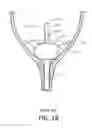 Fig. 19 - Retention drainage catheter