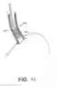 Fig. 40 - Tissue ablation systems and method