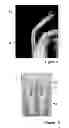 Fig. 07 - ADJUSTABLE DYNAMIC EXTERNAL FIXATOR