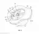 Fig. 04 - Patient-matched guides for orthopedic implants