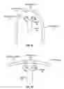 Fig. 02 - MAGNETICALLY-LOCALIZABLE IMPLANTED HEMODIALYSIS VASCULAR ACCESS DEVICES, AND METHODS FOR IMPROVING THE CANNULATION THEREOF